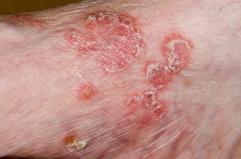 Tularemia – co to jest? Przyczyny, objawy, leczenie